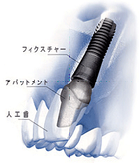 �C���v�����g