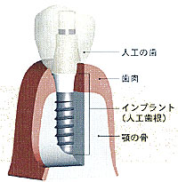 �C���v�����g